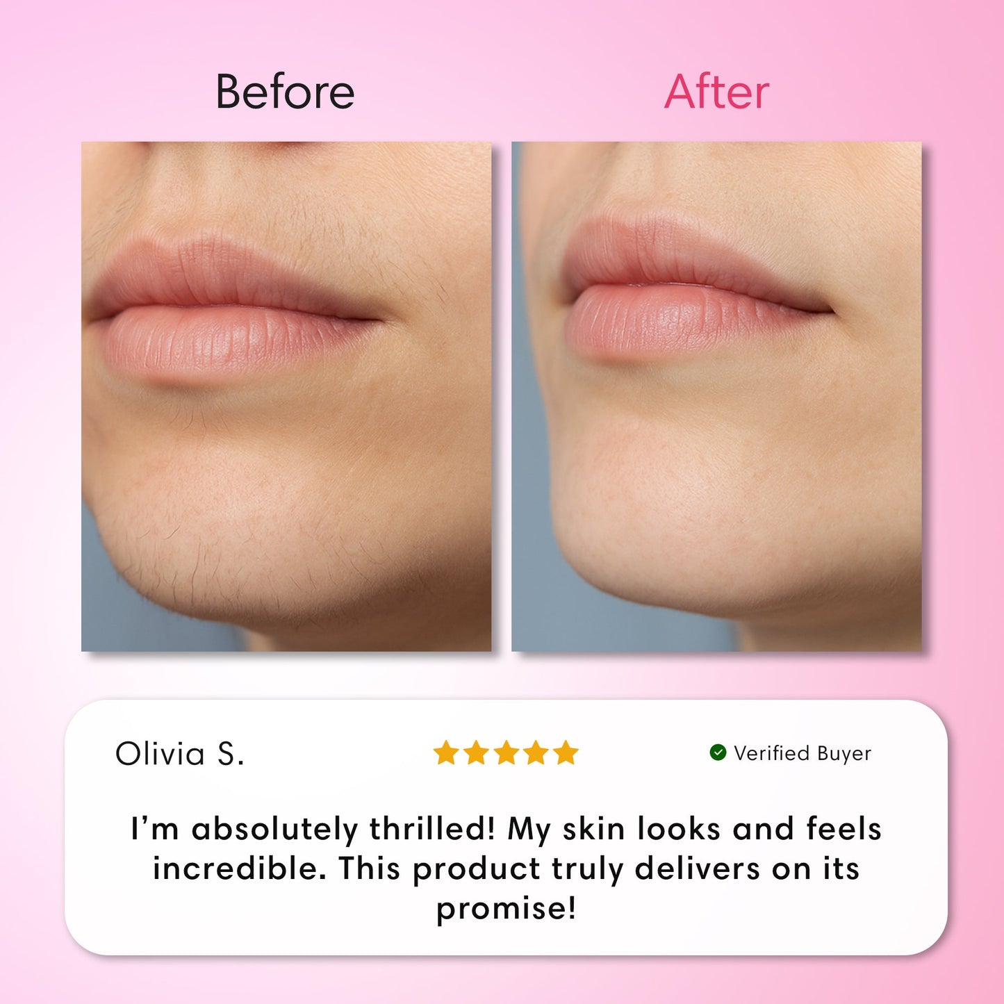 Hair Removal Trilogy Kit