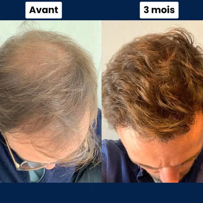 Collagix Micro Infusion - Haar-Regeneration